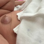 赤ちゃんのでべそが治らない・・・様子見？病院？詳しく解説します！