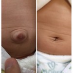 赤ちゃんのでべそを治すにはテープを貼るといいって本当？実際やってみたら・・・