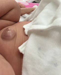 赤ちゃんのでべそが治らない・・・様子見？病院？詳しく解説します！