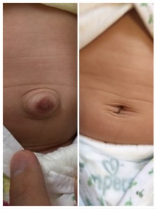 赤ちゃんのでべそを治すにはテープを貼るといいって本当？実際やってみたら・・・